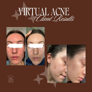 Face Reality * VIRTUAL Acne Program